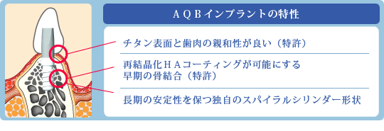 AQBインプラントの特性 AQBインプラントの特性