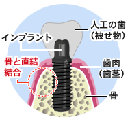 インプラントの仕組み インプラントの仕組み