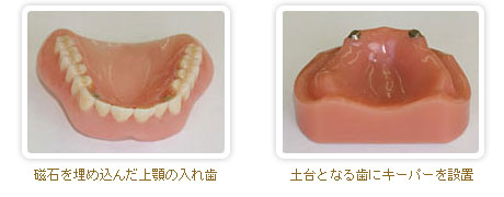 磁性アタッチメント義歯 磁性アタッチメント義歯