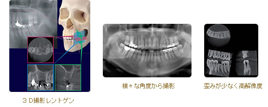 3D画像によるインプラント治療 3D画像によるインプラント治療