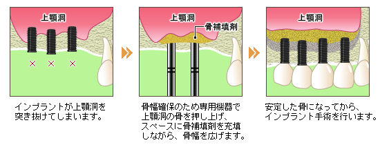 ソケットリフト法 ソケットリフト法